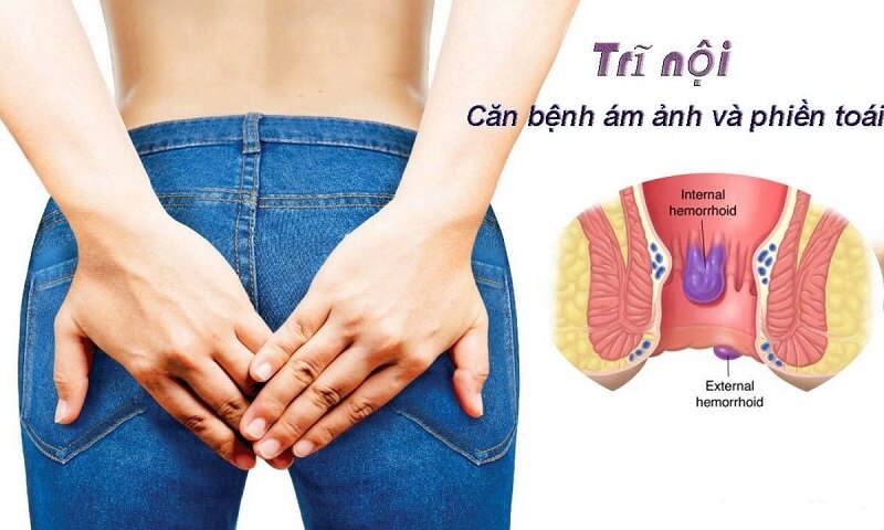 Bệnh trĩ