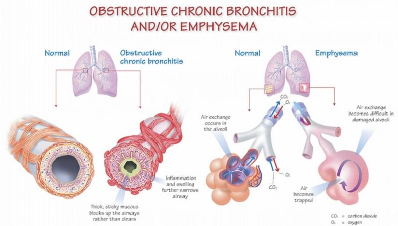 Bệnh viêm phế quản mãn tính